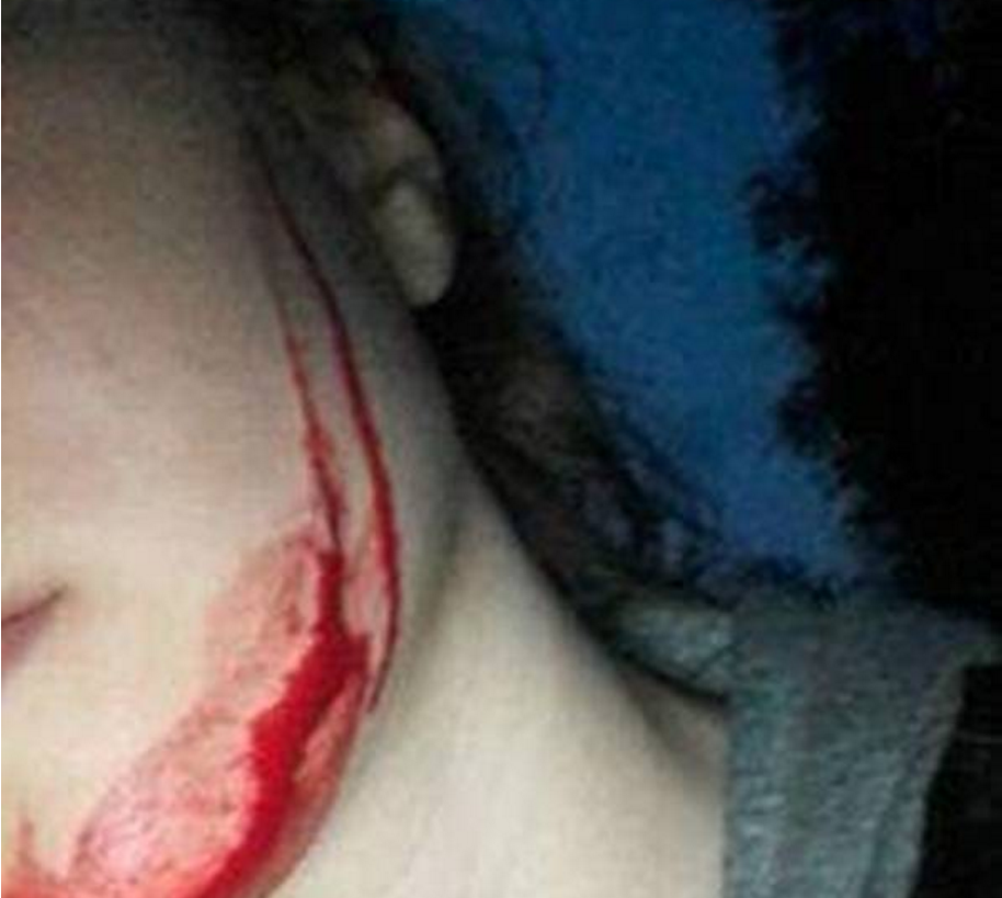 En av jentene som fikk ansiktet skåret opp.